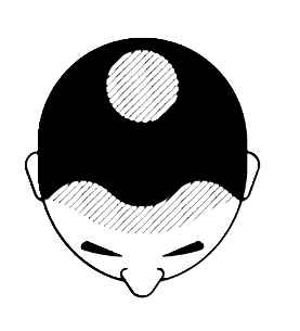 Échelle de Norwood : où en êtes-vous ?