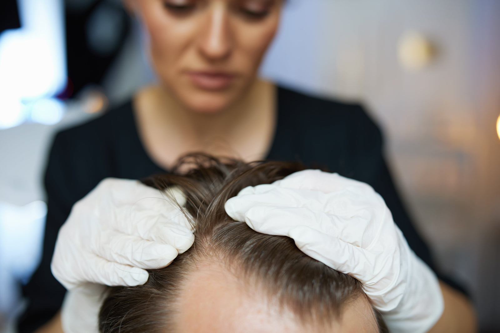 Calvitie masculine : comprendre l'alopécie androgénétique et agir tôt