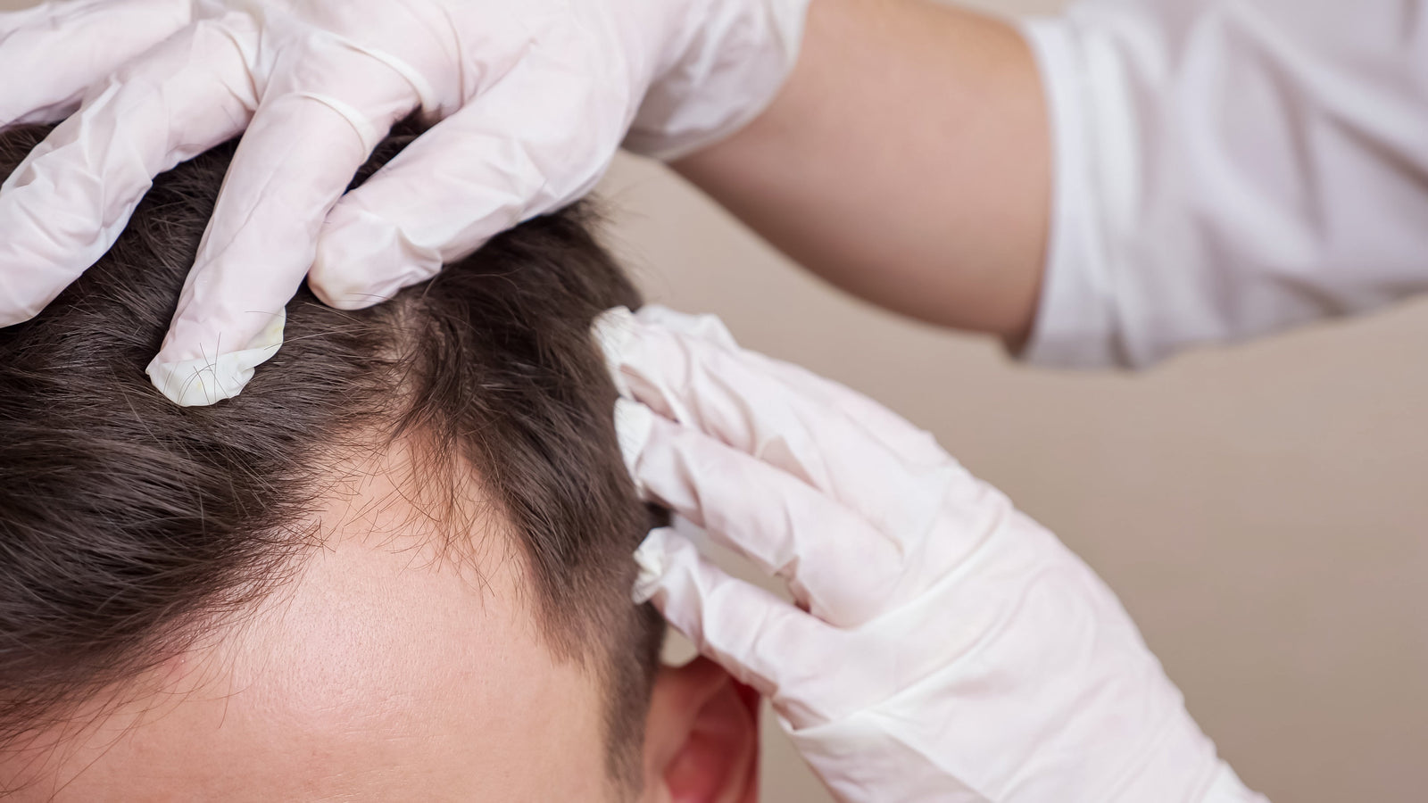 Alopécie androgénétique : comprendre la chute de cheveux la plus fréquente
